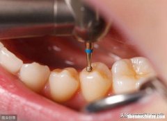 洗牙齿大概多少钱 洗牙齿大概多少钱可以用医保吗?