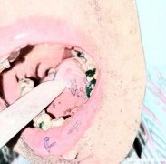 舌癌手术多久能出院 舌癌手术几天可以出院