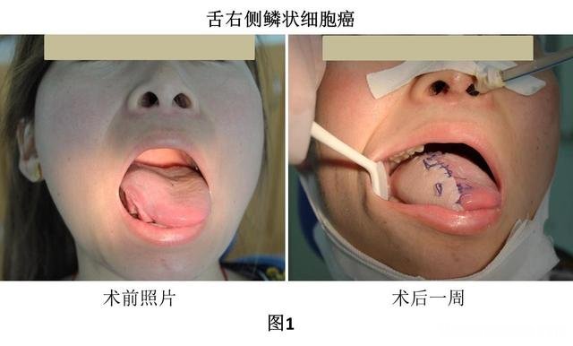 舌癌手术多久能出院 舌癌手术几天可以出院