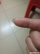 虱子是怎么来的 虱子是怎么来的 放大图片