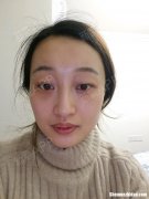 去眼袋手术后多久可以化妆 去眼袋手术后多久可以化妆洗脸