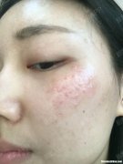 激光祛斑大概多少钱 脸部激光祛斑大概多少钱