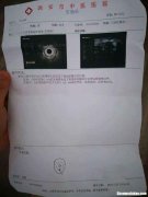 痔疮手术要多少钱 遂宁市痔疮手术要多少钱