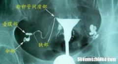 造影怎么做 脑血管造影怎么做