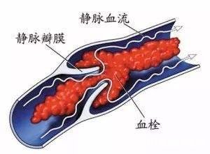 肺栓塞是怎么引起的 剖腹产后肺栓塞是怎么引起的