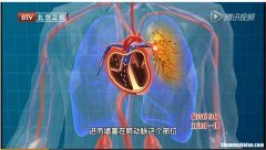 肺栓塞是怎么引起的 剖腹产后肺栓塞是怎么引起的