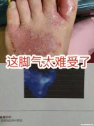 为什么脚气反反复复 为什么脚气反反复复的复发