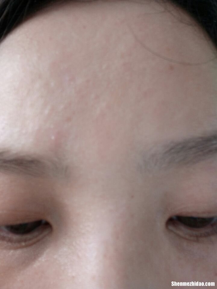额头上为什么长痘痘 额头上为什么长痘痘的原因