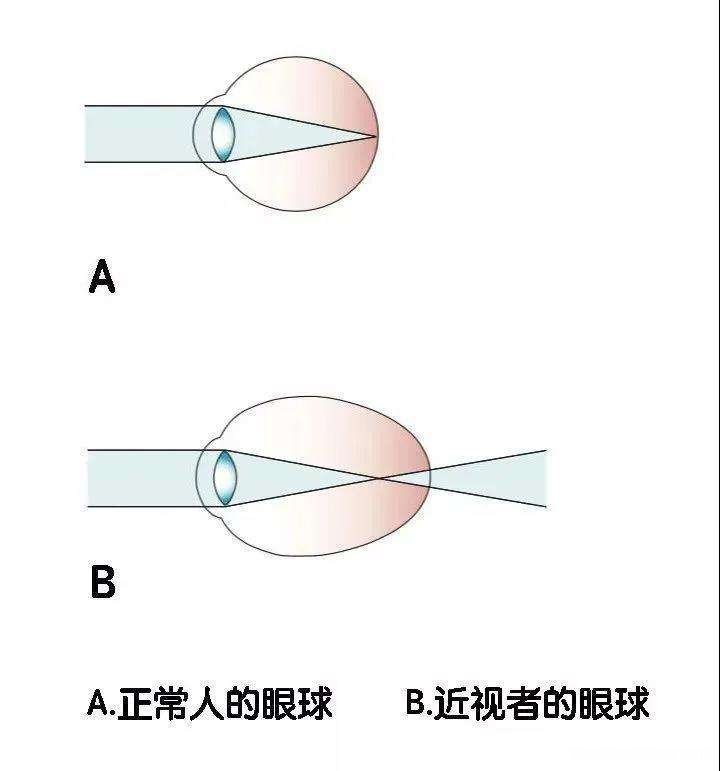 近视多少度会失明 近视的度数高会失明吗