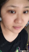 开眼角需要多少钱 儿童开眼角需要多少钱