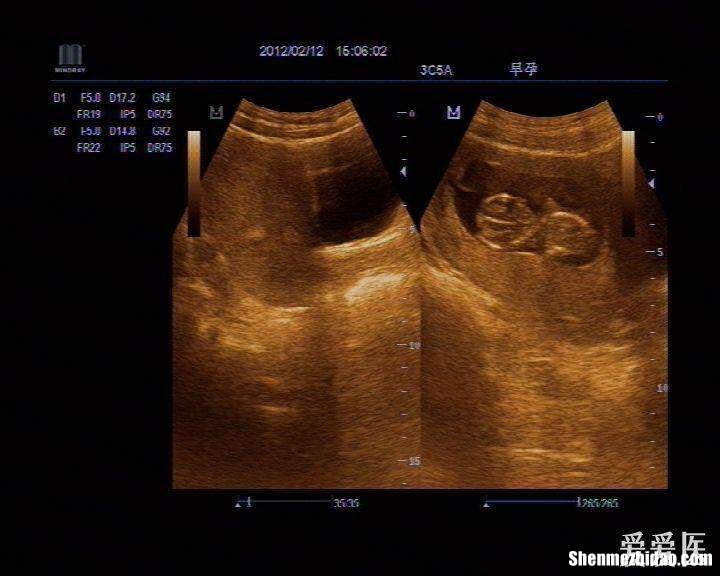 双***怀孕下面老流血 双***怀孕后另一个***会出血吗