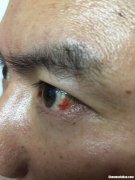 眼镜为什么会红 眼睛为什么会红血丝
