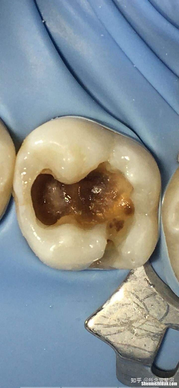 如何补牙 如何补牙洞过程