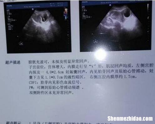 双***怀孕要注意什么 双***怀孕要注意什么事项