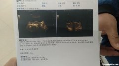 双***怀孕要注意什么 双***怀孕要注意什么事项