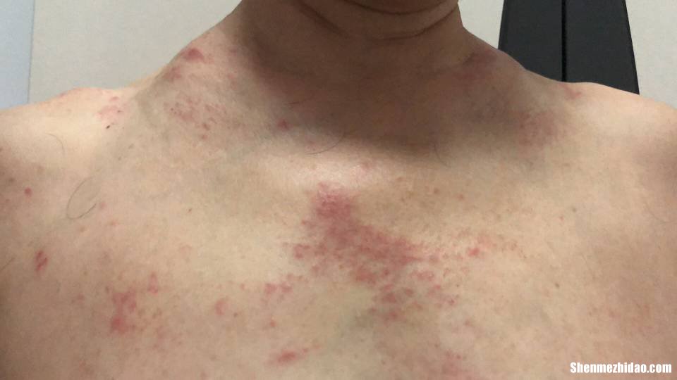 b痒难受怎么办 激素脸痒难受怎么办才好