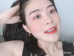 整牙拔牙多久后带牙套 整牙拔牙多久后带牙套较好