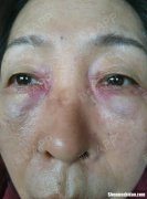 激光洗唇线多久消肿 激光洗唇线后黑色素沉着了怎么办