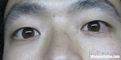 眼球有黄斑是怎么回事 眼球有黄色斑点是怎么回事