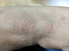 手脚都是小水泡奇痒怎么办呢 手脚都是小水泡奇痒怎么办呢吃什么药
