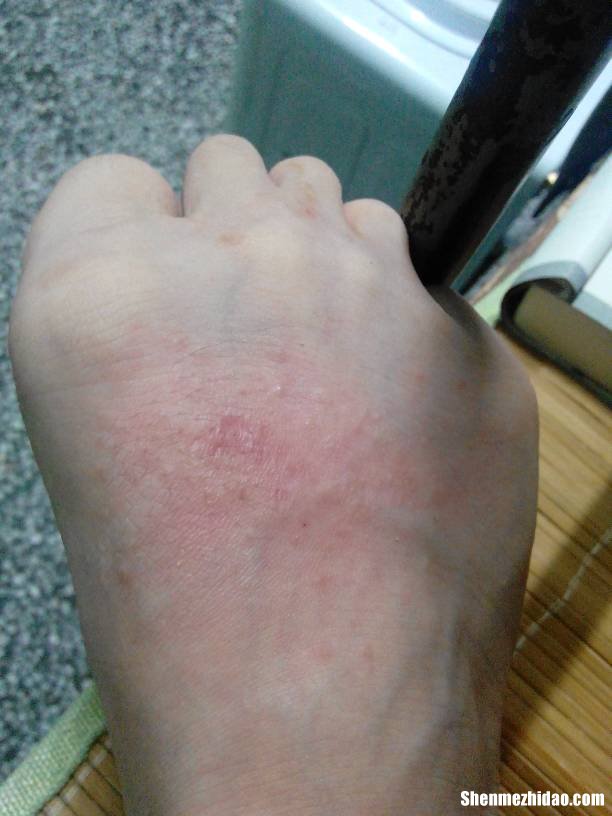 手脚都是小水泡奇痒怎么办呢 手脚都是小水泡奇痒怎么办呢吃什么药