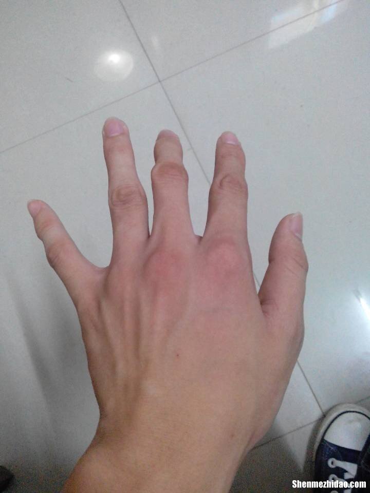 手骨折会怎么样 手骨折怎么样消肿快