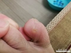 糖尿病长鸡眼了怎么办 糖尿病人鸡眼破损有半年了