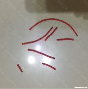 线头排异取出后多久会好 线头排异取出后多久会好起来