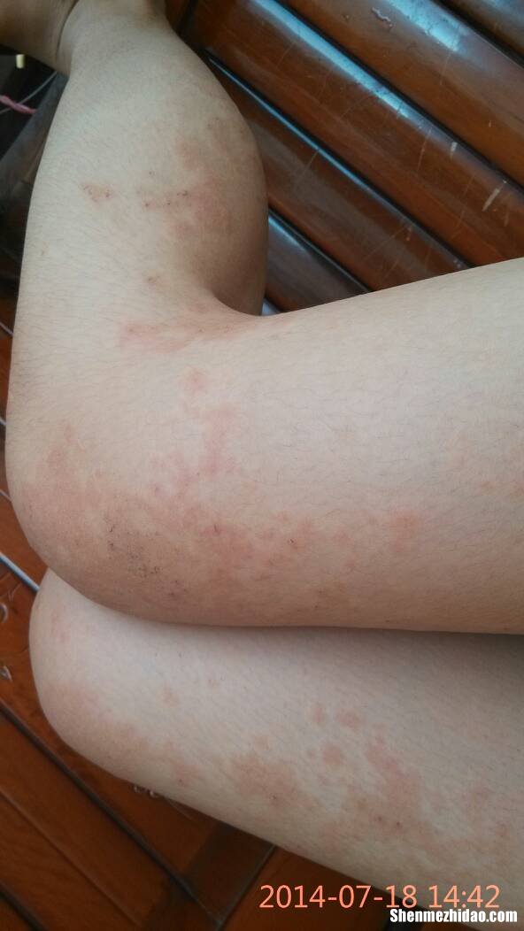 老人腿总痒怎么办 老人腿痒怎么办特别是在晚上