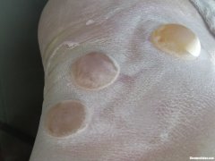 膏药过敏起水泡怎么治 膏药过敏起泡还不停的出黄水怎么办