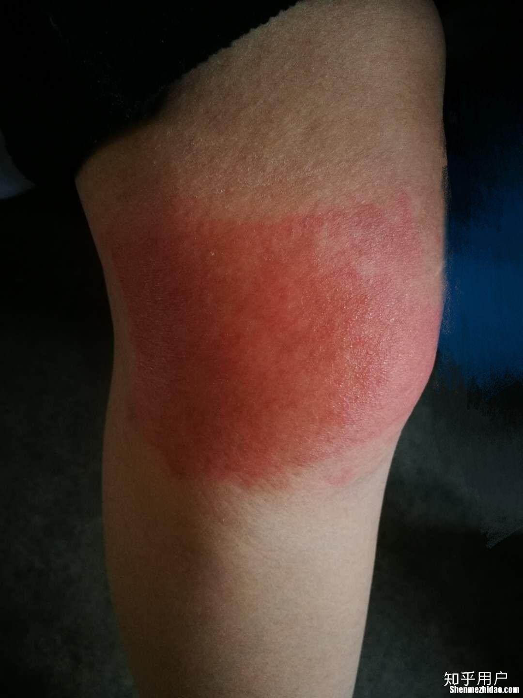 膏药过敏起水泡怎么治 膏药过敏起泡还不停的出黄水怎么办