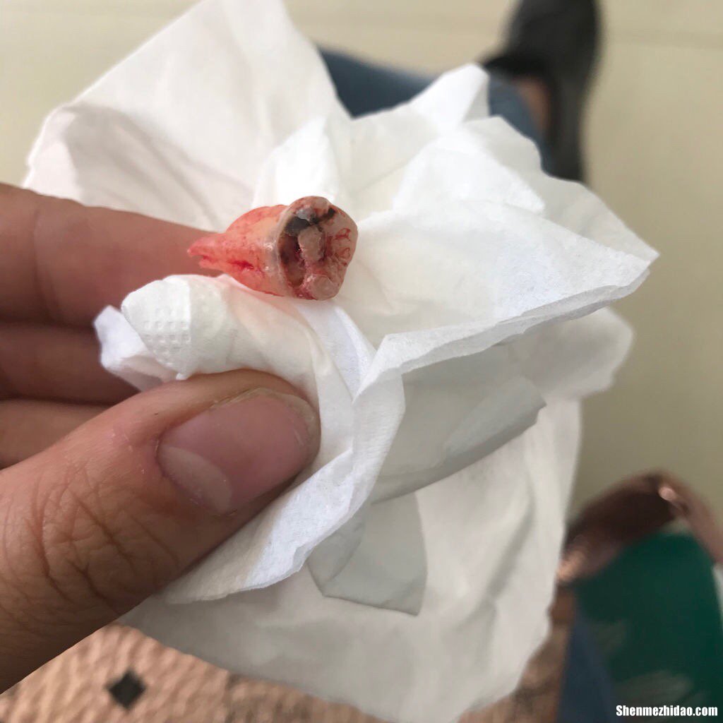 智齿拔了多久消肿 拔智齿后那个洞臭到恶心