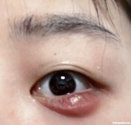 针眼有脓怎么办 针眼有脓包怎么办