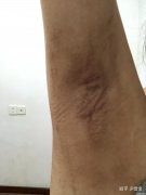 腋臭手术要恢复多久 腋臭手术完全恢复多久