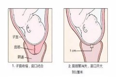 宫颈成熟度2多久能生 宫颈成熟度2 多久能生
