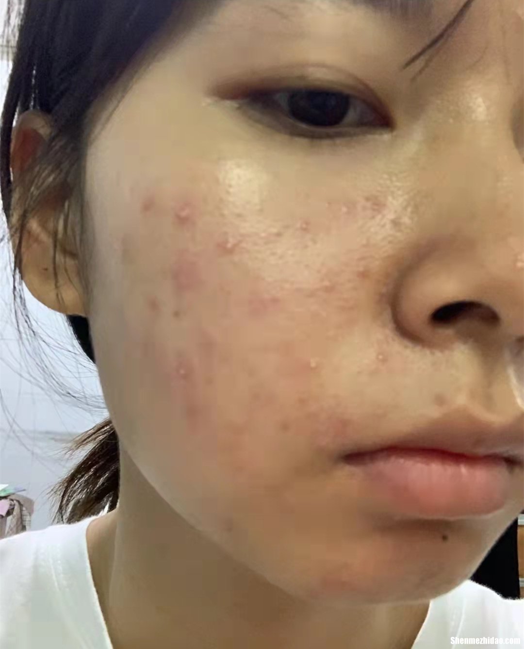 脸上的痘印怎么快速去除 脸上的痘印怎么快速去除小妙招