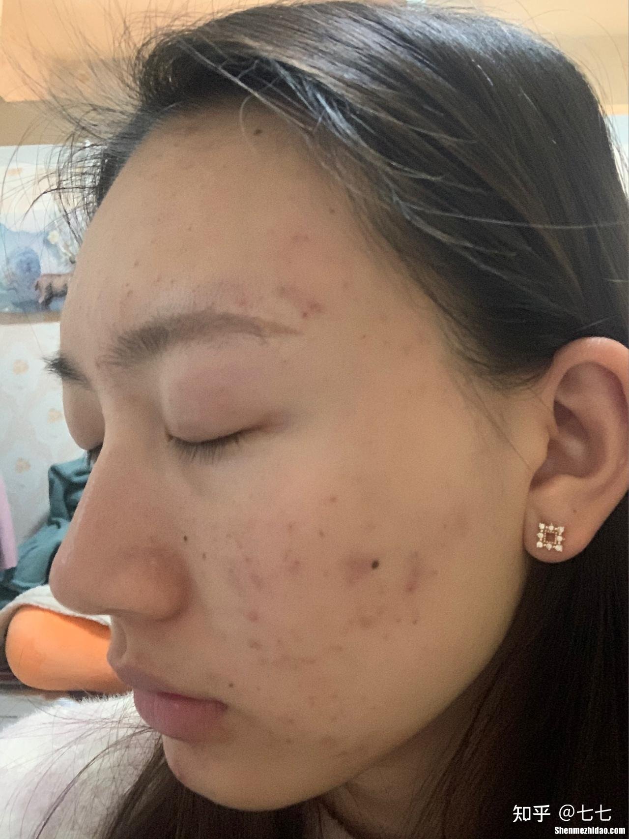 脸上的痘印怎么快速去除 脸上的痘印怎么快速去除小妙招