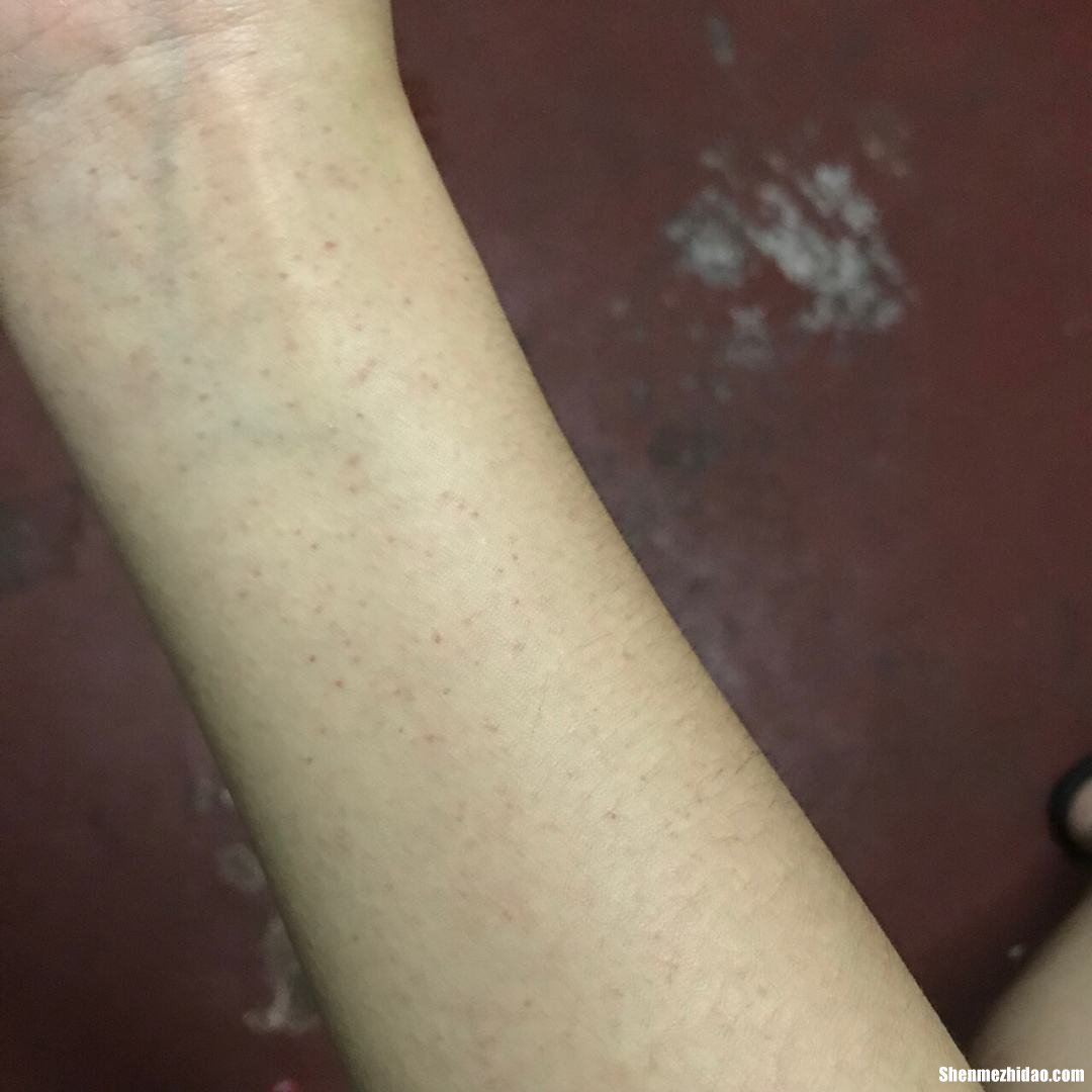 过敏性紫癜怎么老是起红点呢 过敏性紫癜怎么老是起红点呢怎么回事