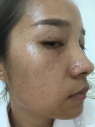 冬天点斑结痂后多久掉 冬天点斑结痂后多久掉完