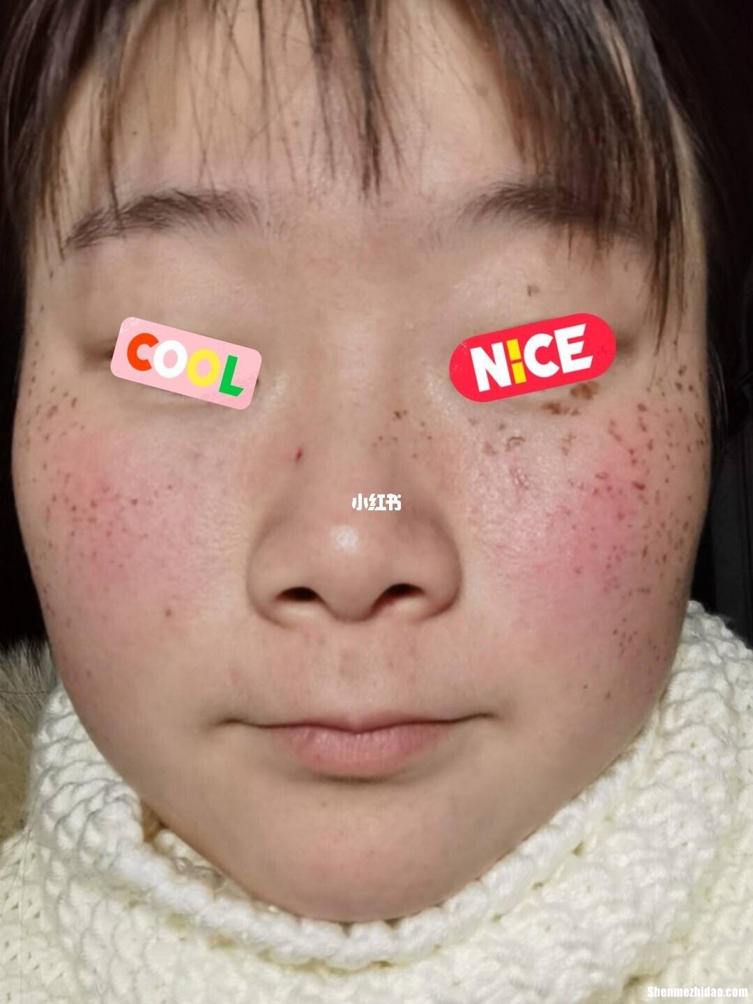 冬天点斑结痂后多久掉 冬天点斑结痂后多久掉完