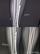 腓骨骨折一般多久下地 腓骨骨折一般多久下地走路