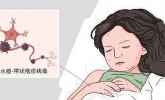 孕妇患生蛇病怎么办 孕妇得了蛇缠腰怎么办