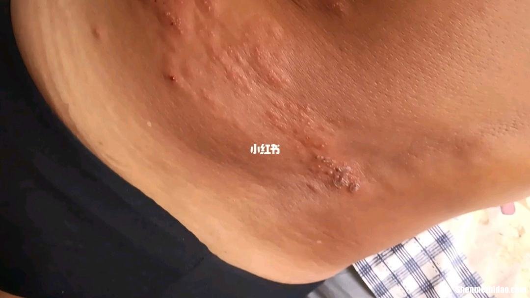 带状疱疹多久才不痛 带状疱疹多久才不痛痒