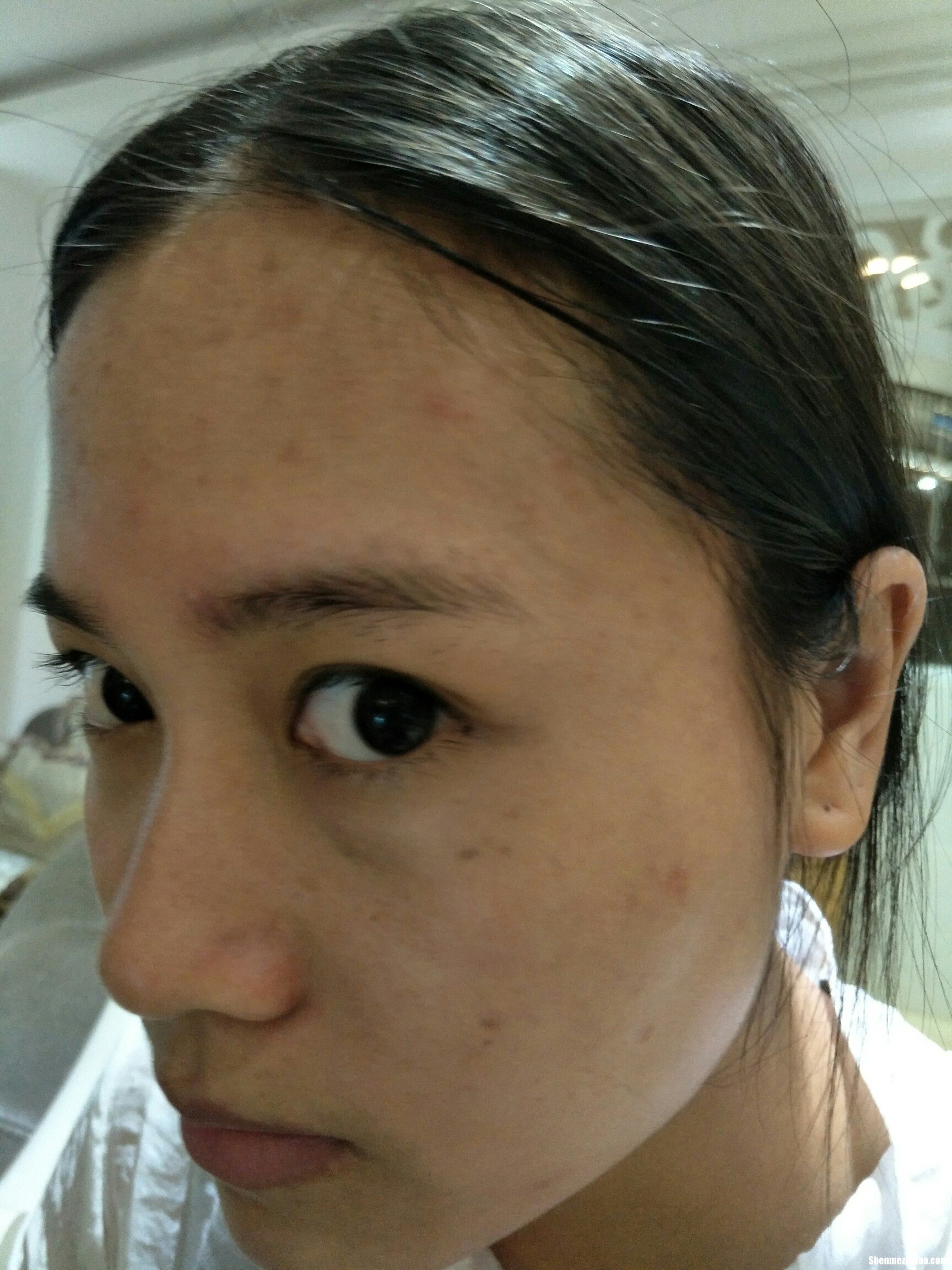 点痣点斑多久会好 点痣点斑多久才能恢复