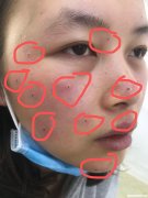 点痣点斑多久会好 点痣点斑多久才能恢复