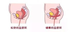 产后漏尿一般多久能好 产后漏尿多久能自愈平时怎样注意