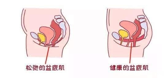 产后漏尿一般多久能好 产后漏尿多久能自愈平时怎样注意