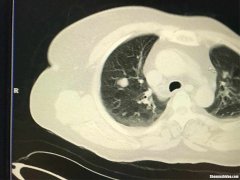 肺癌空洞要多久形成 肺癌空洞一般有几厘米