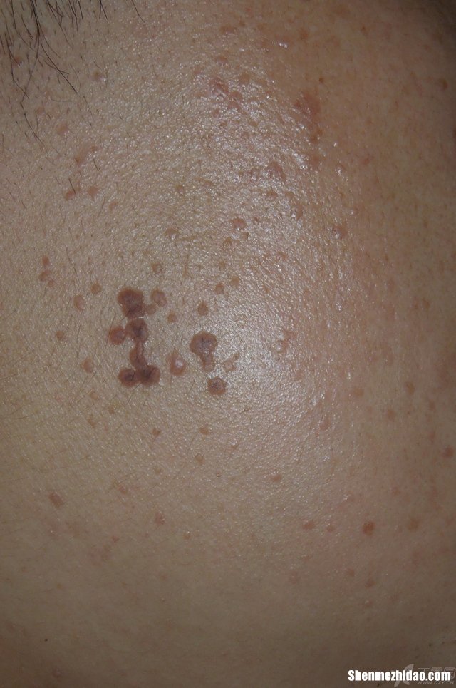 喝中药扁平疣多久痊愈 喝中药扁平疣变淡变平了了