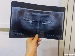 拔智齿热敷多久 拔智齿热敷多久一次